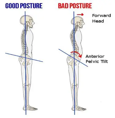 Good Posture Versus Bad Posture
